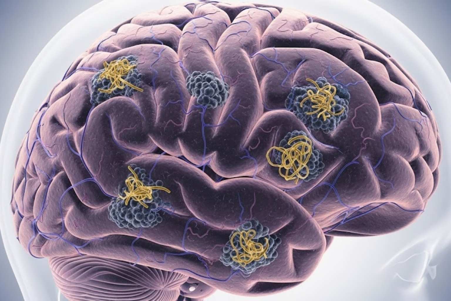 Dra. Erika Tavares, neurologista em Joinville, Jaraguá do Sul, Pomerode, Blumenau, Florianópolis. Saúde cerebral Alzheimer