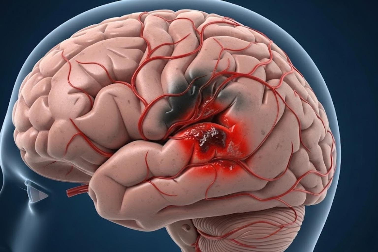 Dra. Erika Tavares, neurologista em Joinville, Jaraguá do Sul, Pomerode, Blumenau, Florianópolis. Saúde cerebral AVC